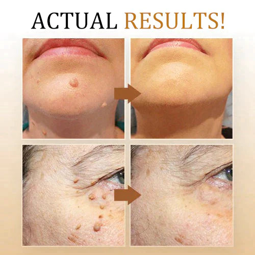 SkinPure | Wart & Skin Tag Spray – Fast-Acting, Precision Nozzle