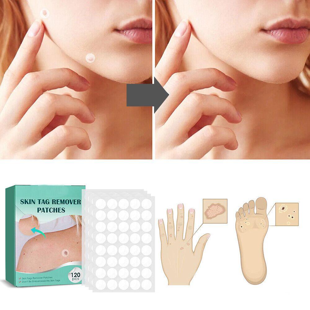 ClearDerm | Wart Removal Strips – Safe & Comfortable for All Skin