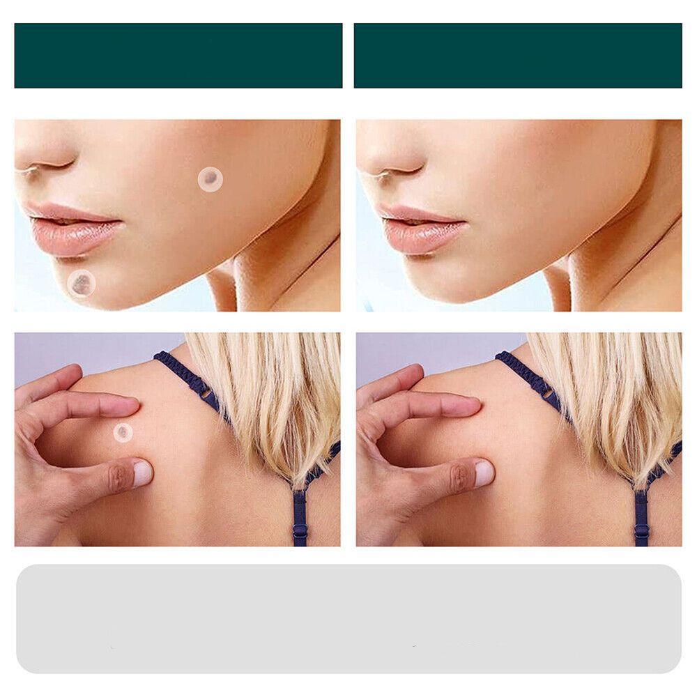 ClearDerm | Wart Removal Strips – Safe & Comfortable for All Skin