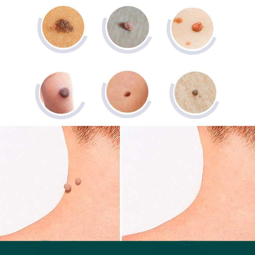 ClearDerm | Wart Removal Strips – Safe & Comfortable for All Skin