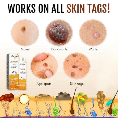 SkinPure | Wart & Skin Tag Spray – Fast-Acting, Precision Nozzle